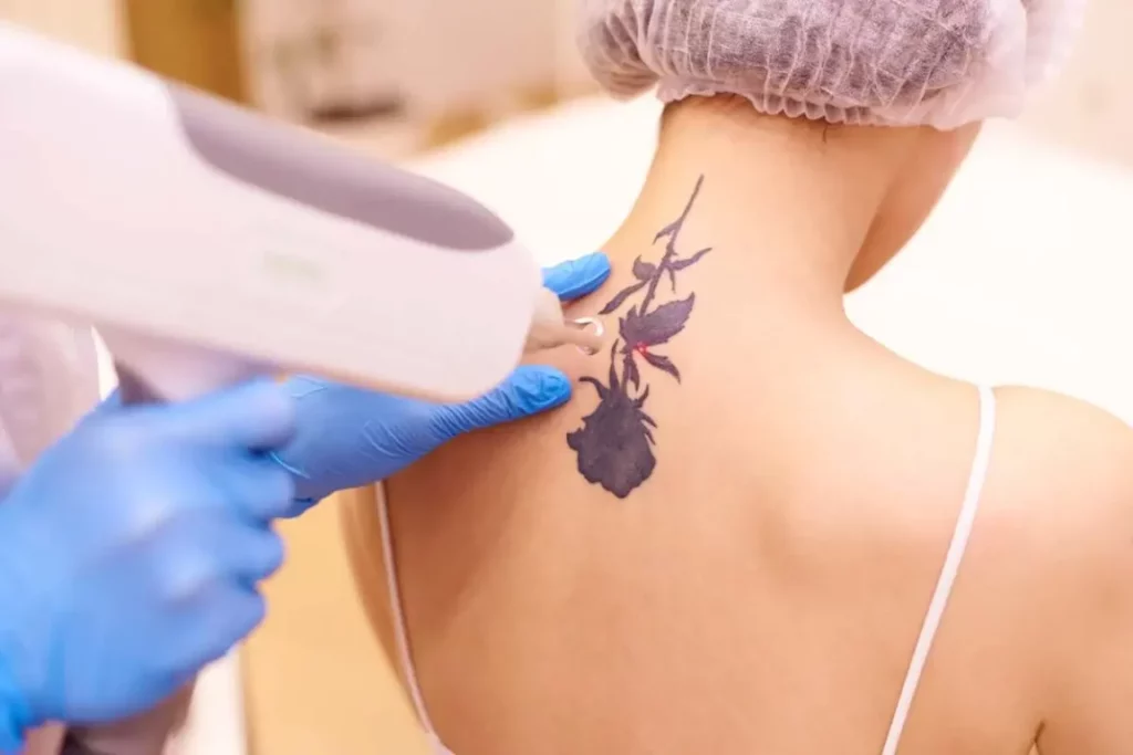 Laser-Tattoo-Removal-by-The-Wellness-Co-in-Santee-CA-1024x683