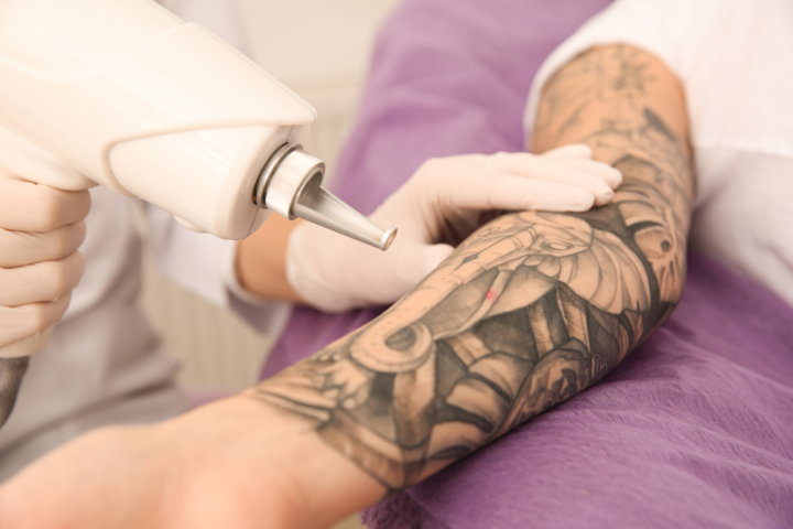 tattoo removal