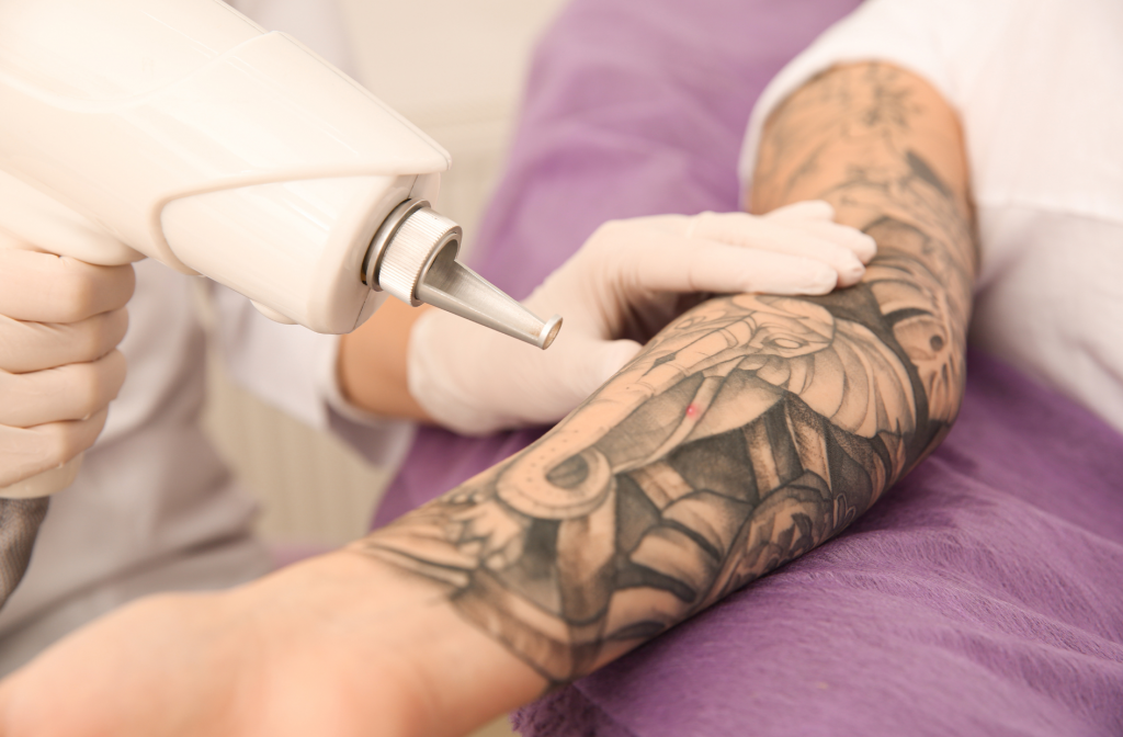 tattoo removal