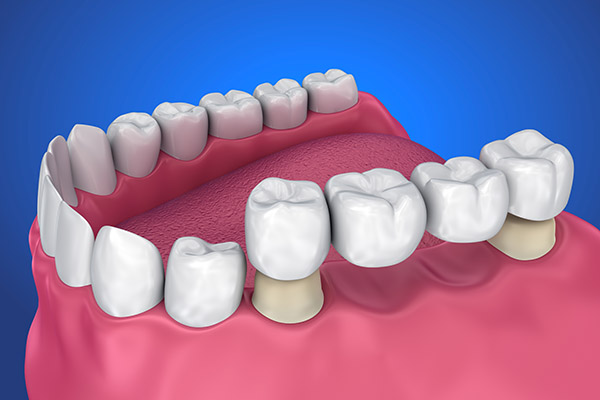Understanding Your Options for Replacing Missing Teeth