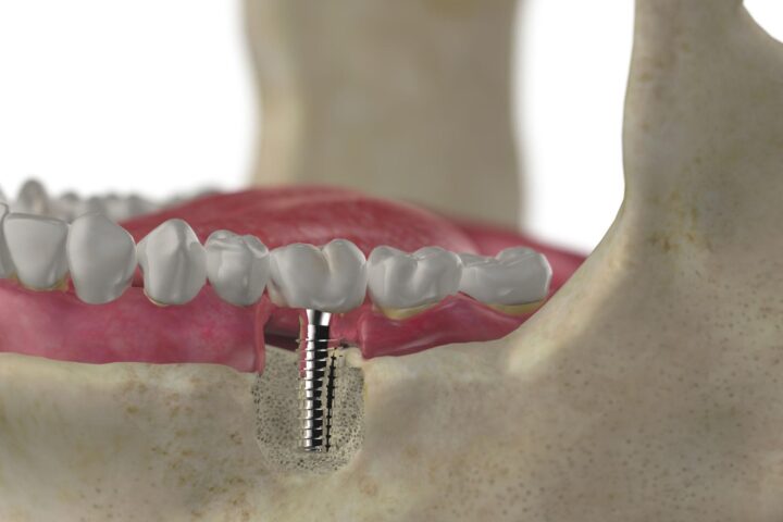 dental implants